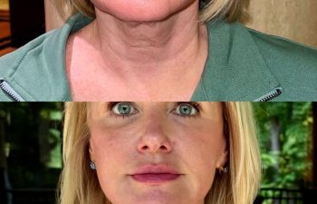 female patient before and after EVELIFT®