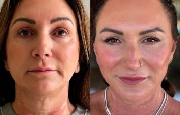 female patient before and after EVELIFT®