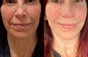 female patient before and after EVELIFT®