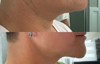 female patient before and after EVELIFT®