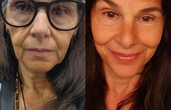 female patient before and after EVELIFT®