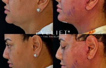 female patient before and after EVELIFT®