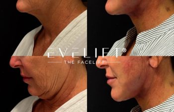 female patient before and after EVELIFT®