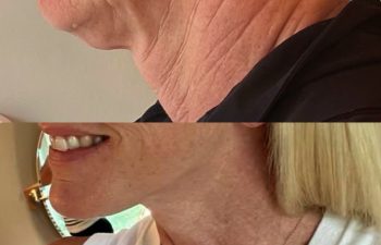 female patient before and after EVELIFT®
