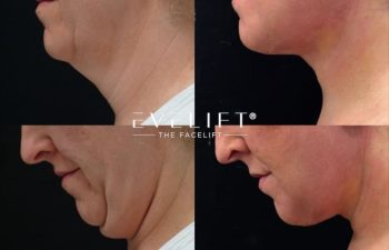 female patient before and after EVELIFT®