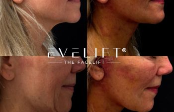female patient before and after EVELIFT®
