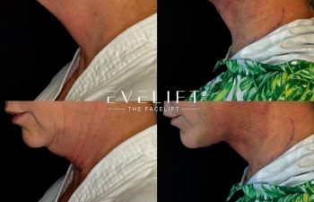 female patient before and after EVELIFT®