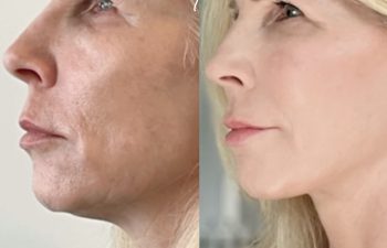 female patient before and after EVELIFT®