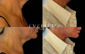 female patient before and after EVELIFT®