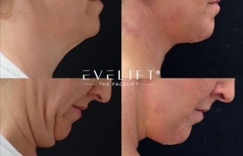 female patient before and after EVELIFT®