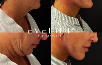 female patient before and after EVELIFT®