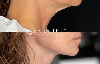 female patient before and after EVELIFT®