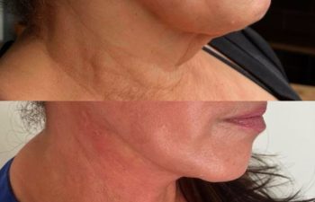 female patient before and after EVELIFT®