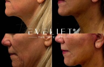 female patient before and after EVELIFT®