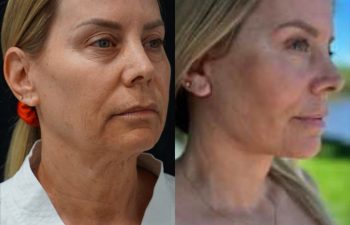 female patient before and after EVELIFT®