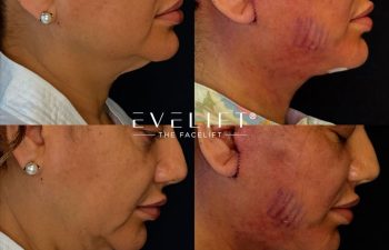 female patient before and after EVELIFT®