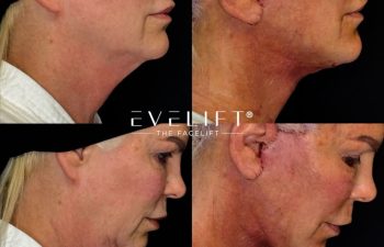 female patient before and after EVELIFT®