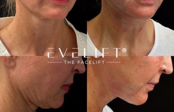 female patient before and after EVELIFT®