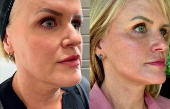 female patient before and after EVELIFT®