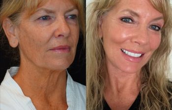female patient before and after EVELIFT®