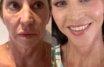 female patient before and after EVELIFT®