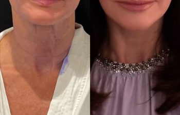 female patient before and after EVELIFT®
