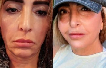 female patient before and after EVELIFT®