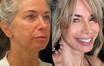 female patient before and after EVELIFT®