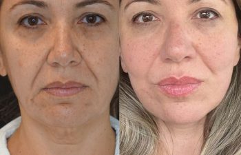 female patient before and after EVELIFT®