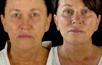 female patient before and after EVELIFT®