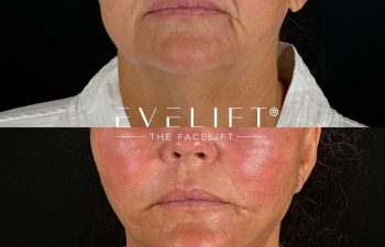 female patient before and after EVELIFT®