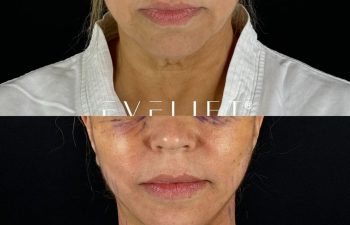 female patient before and after EVELIFT®