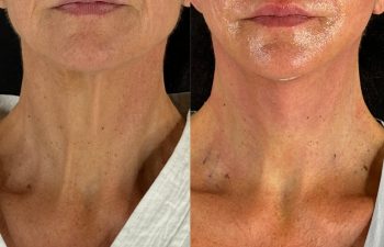 female patient before and after EVELIFT®