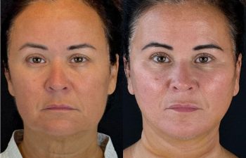 female patient before and after EVELIFT®
