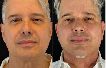 male patient before and after EVELIFT®