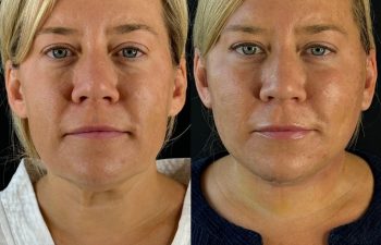female patient before and after EVELIFT®