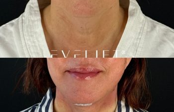 female patient before and after EVELIFT®