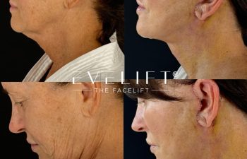 female patient before and after EVELIFT®