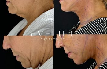 female patient before and after EVELIFT®