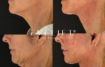 female patient before and after EVELIFT®