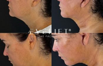 female patient before and after EVELIFT®