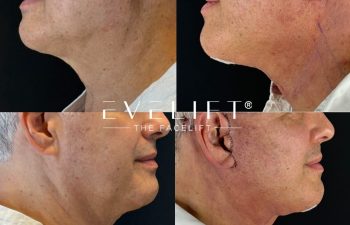 male patient before and after EVELIFT®
