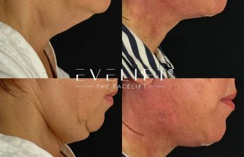 female patient before and after EVELIFT®