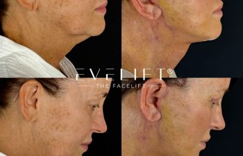 female patient before and after EVELIFT®