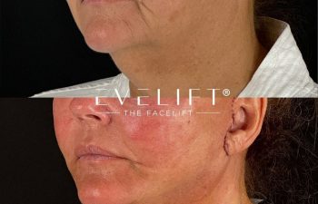 female patient before and after EVELIFT®