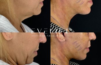 female patient before and after EVELIFT®