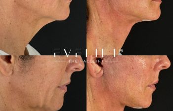 female patient before and after EVELIFT®