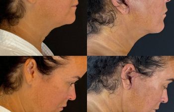 female patient before and after EVELIFT®