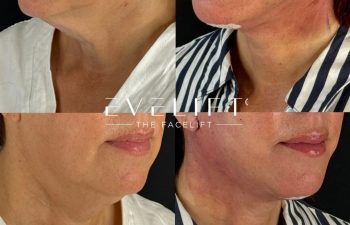 female patient before and after EVELIFT®