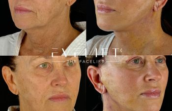 female patient before and after EVELIFT®